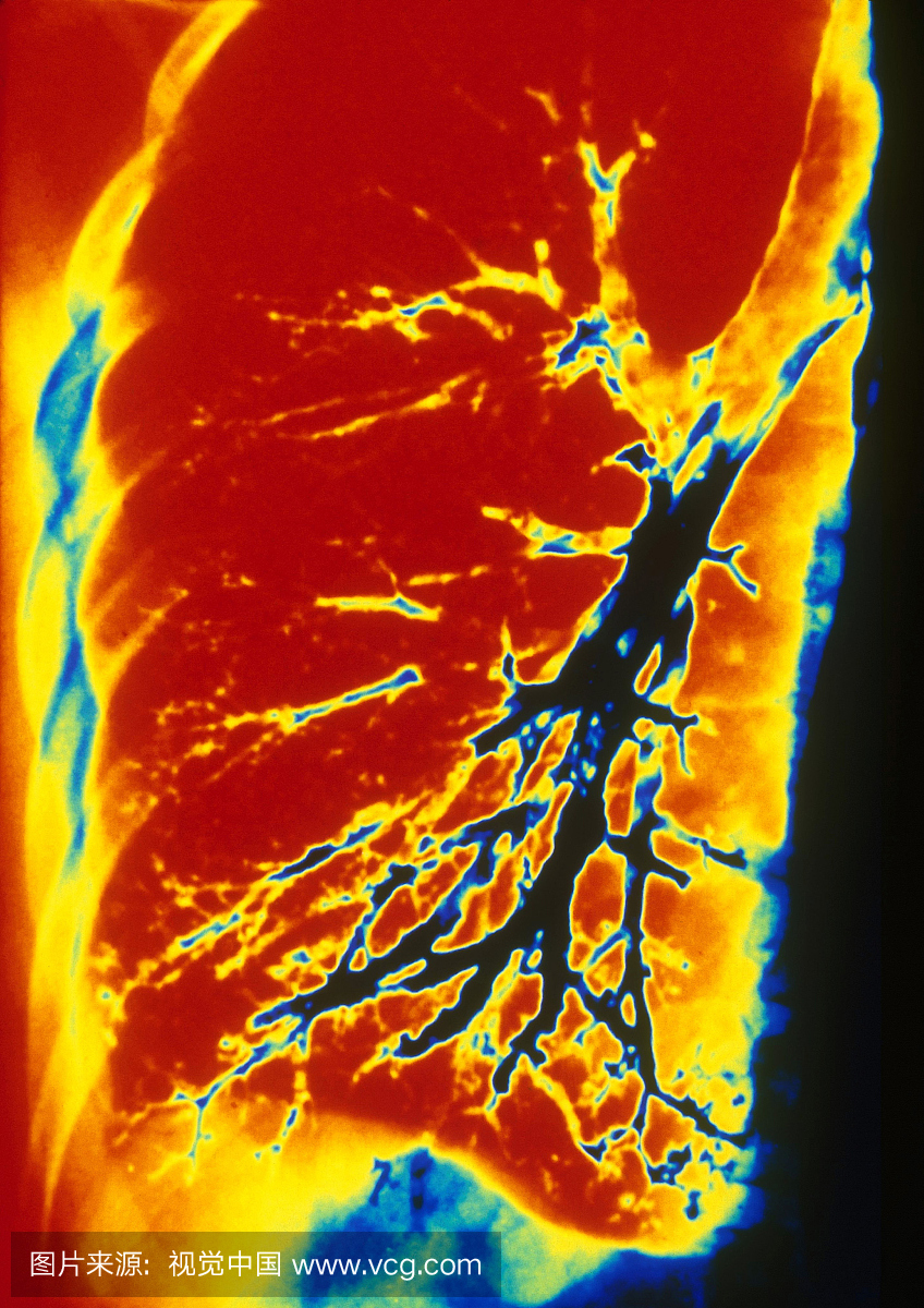 人肺支气管的彩色支气管镜(X光片)。支气管造