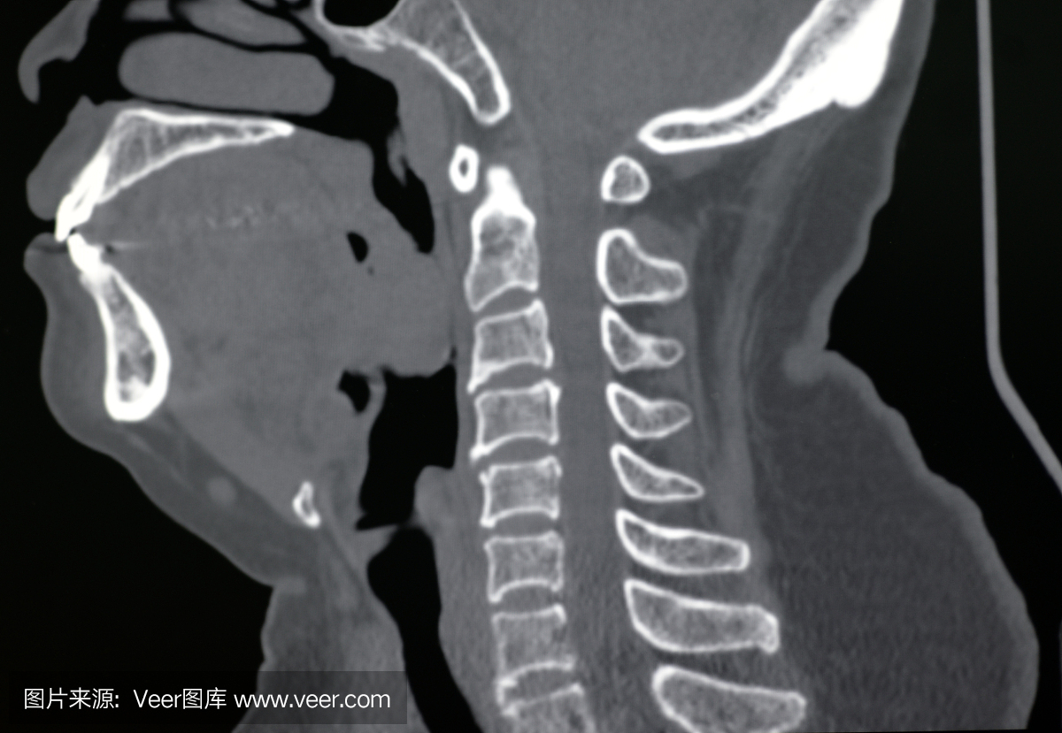 人体颈椎CT图像(骨窗)