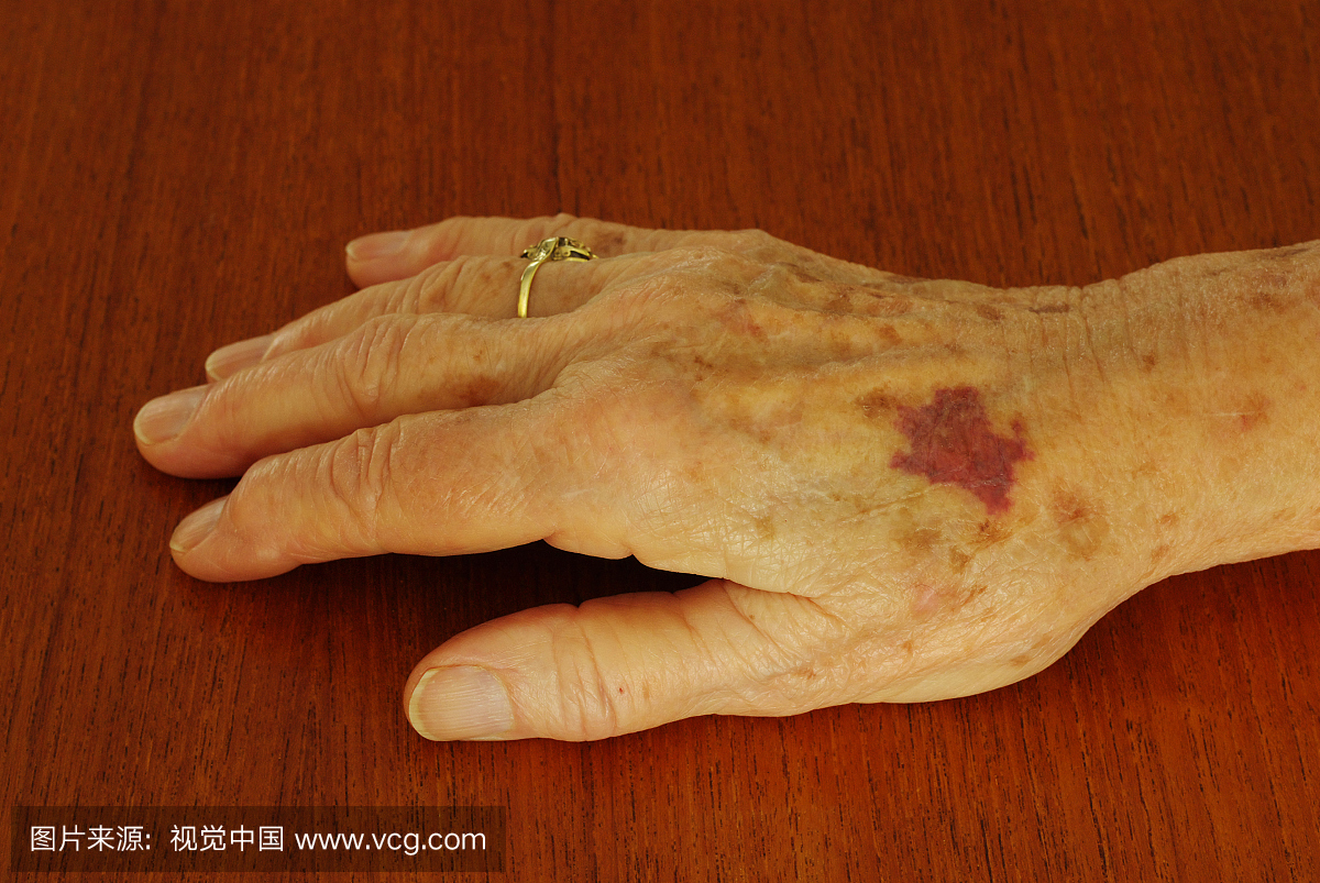 老年性紫癜是易患易感性的常见病症,最常见于