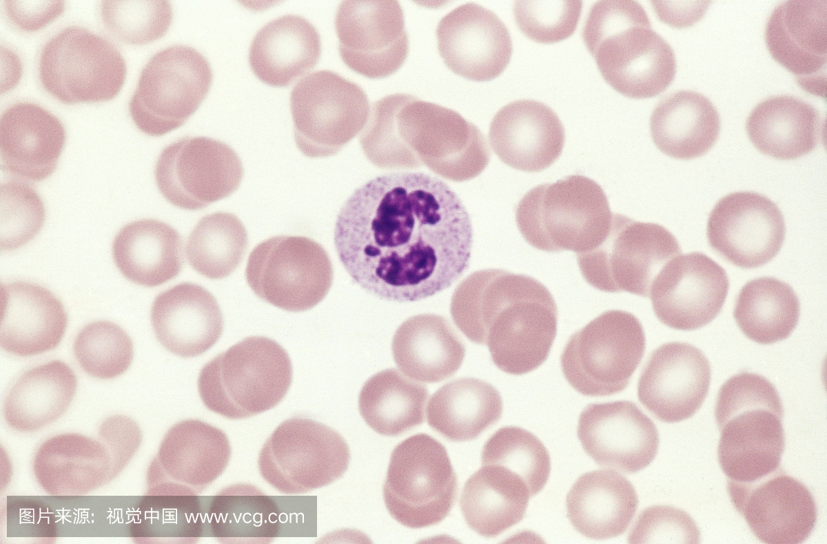 人类血液涂片显示嗜中性粒细胞与鼓槌染色体(