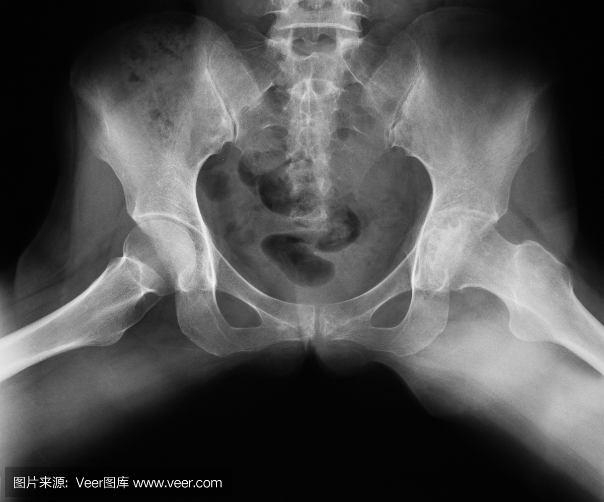 髋关节,青蛙腿的X射线图像位置,显示髋关节骨