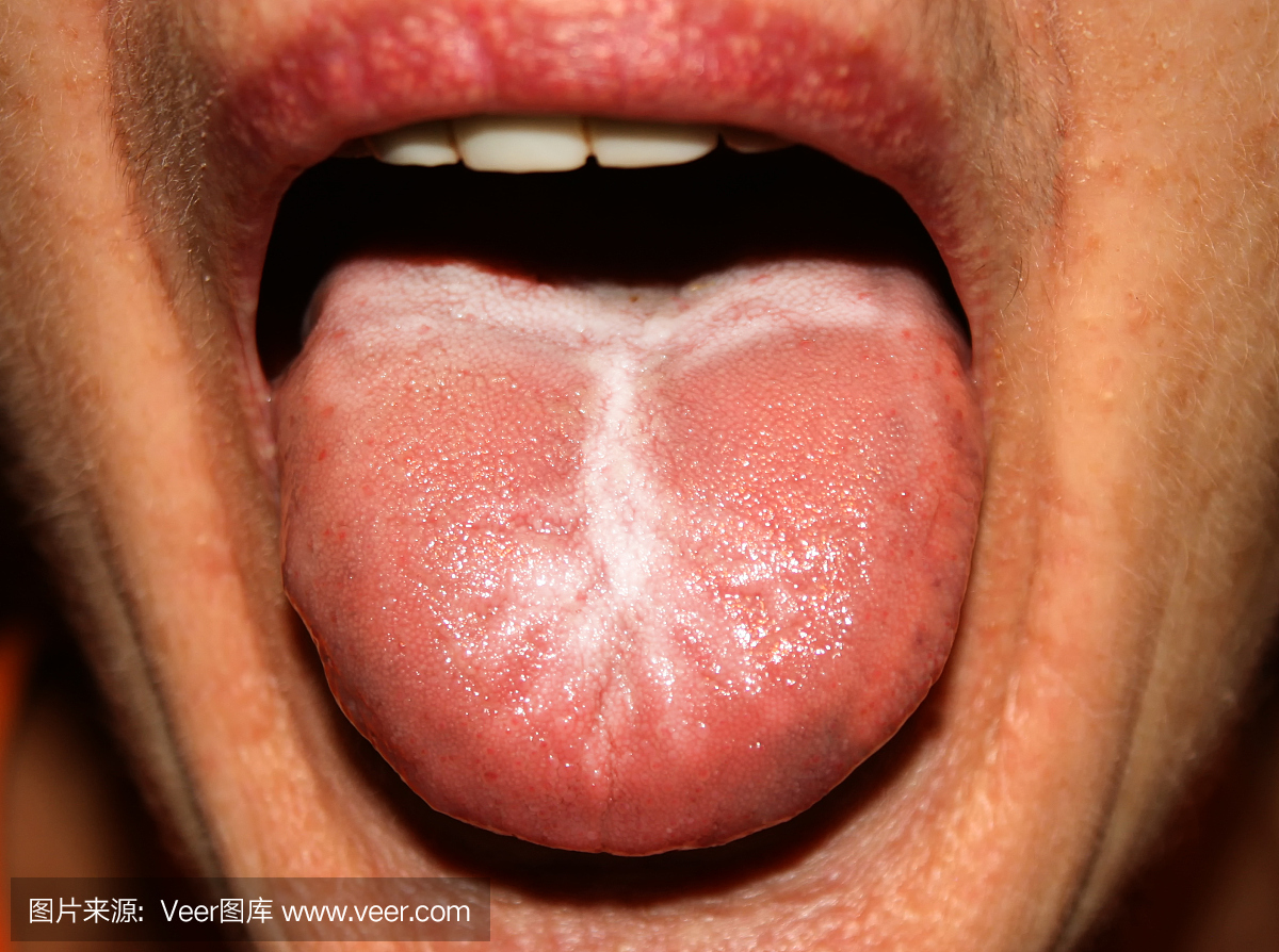 舌头念珠菌病。白色涂层。画眉。