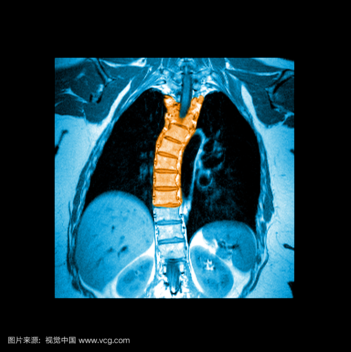胸廓脊柱的这种增强冠状(正面)T1加权MRI图像