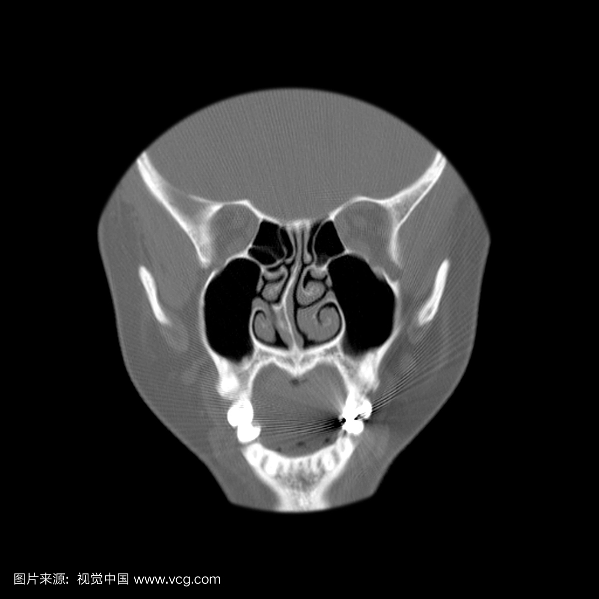 鼻旁鼻窦和鼻腔的冠状(正面)CT显示鼻中隔的典