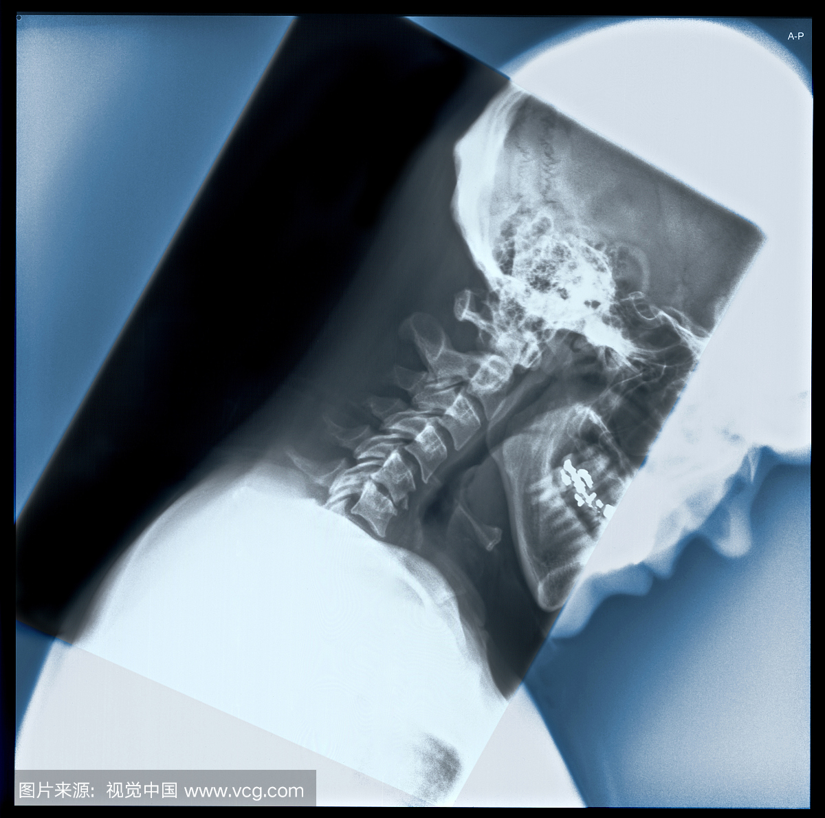 这个x射线是横向颈椎研究,以观察屈曲运动范围