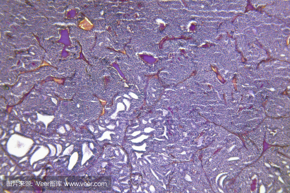 扩大甲状腺腺瘤性增生