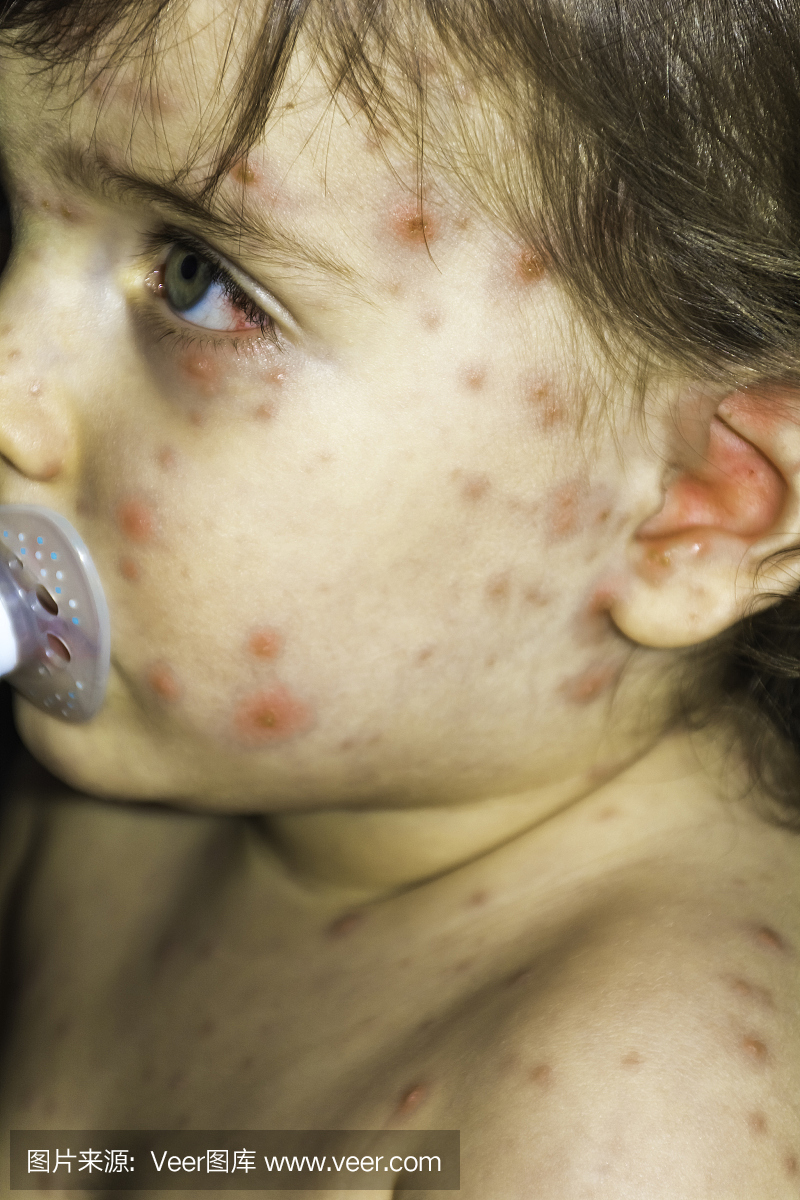 关闭水痘病毒或水痘泡沫疹和水泡上婴儿的脸和