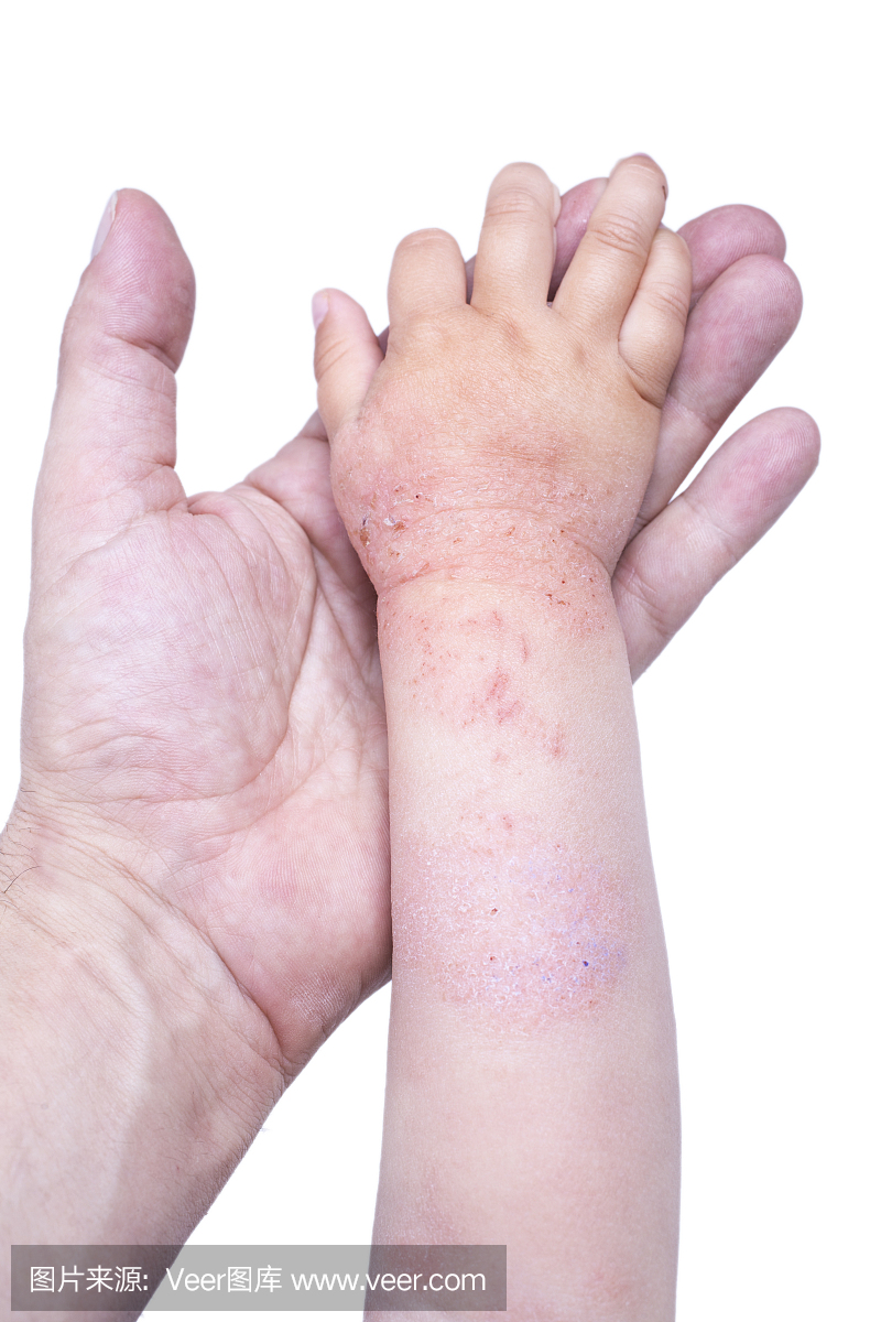 湿疹在孩子的手上