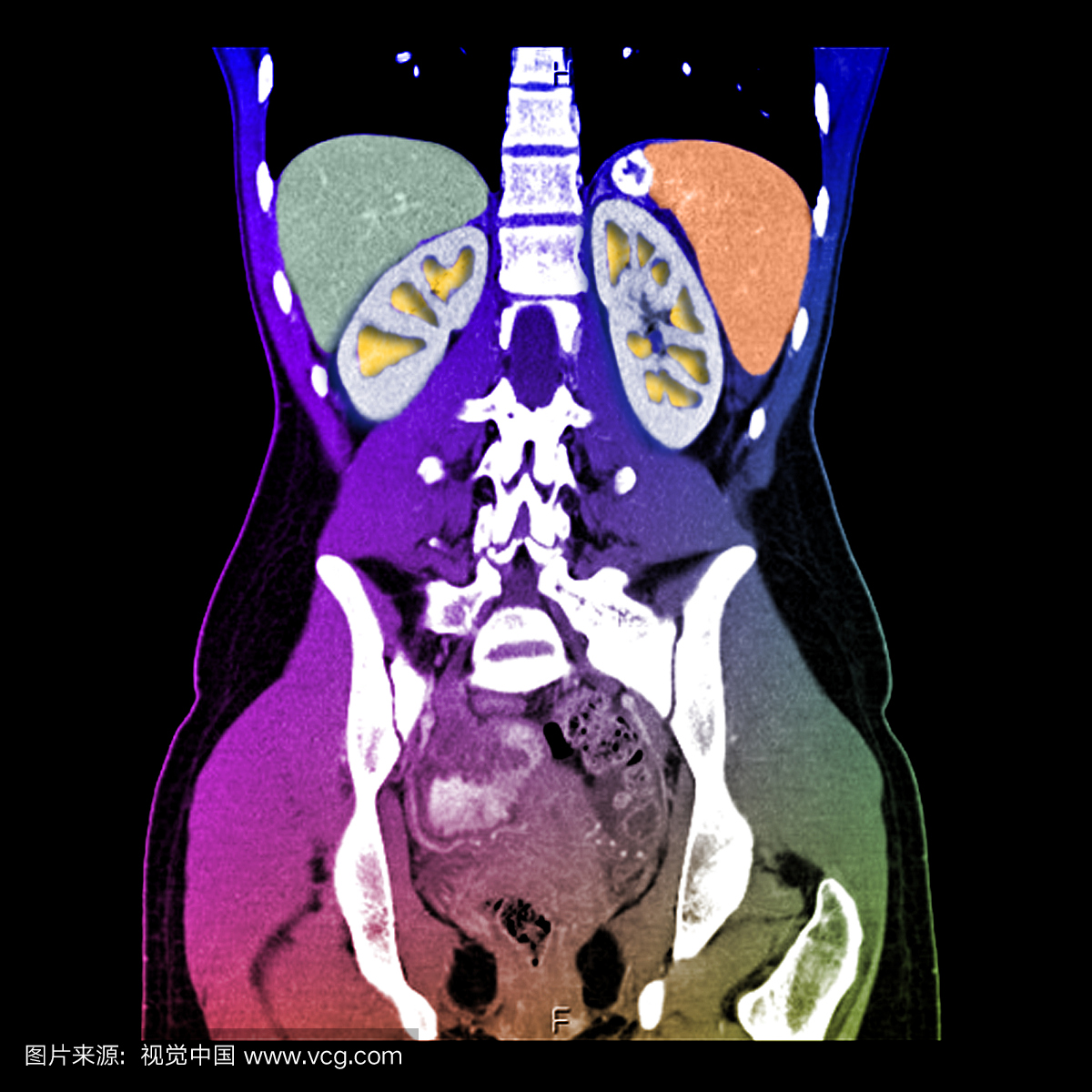 下胸部,腹部和骨盆的这种增强冠状CT扫描显示