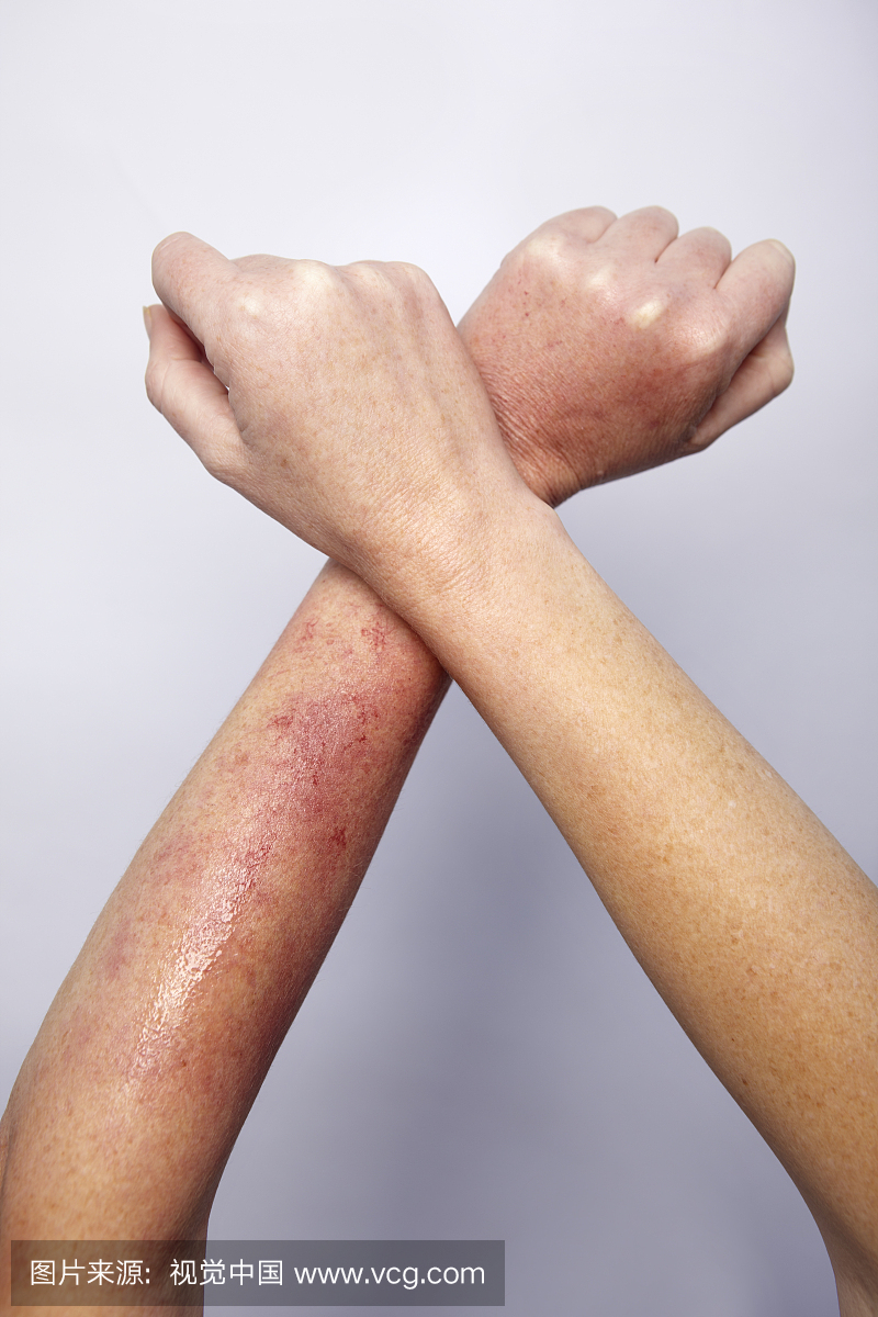 灼伤,晒伤的,晒黑,晒伤