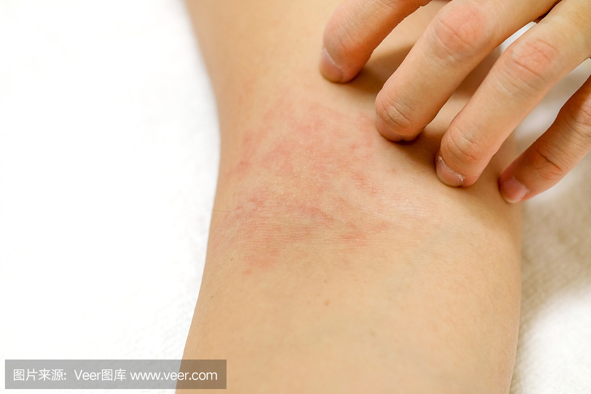 妇女的手抓过敏在白色背景上的红色皮疹