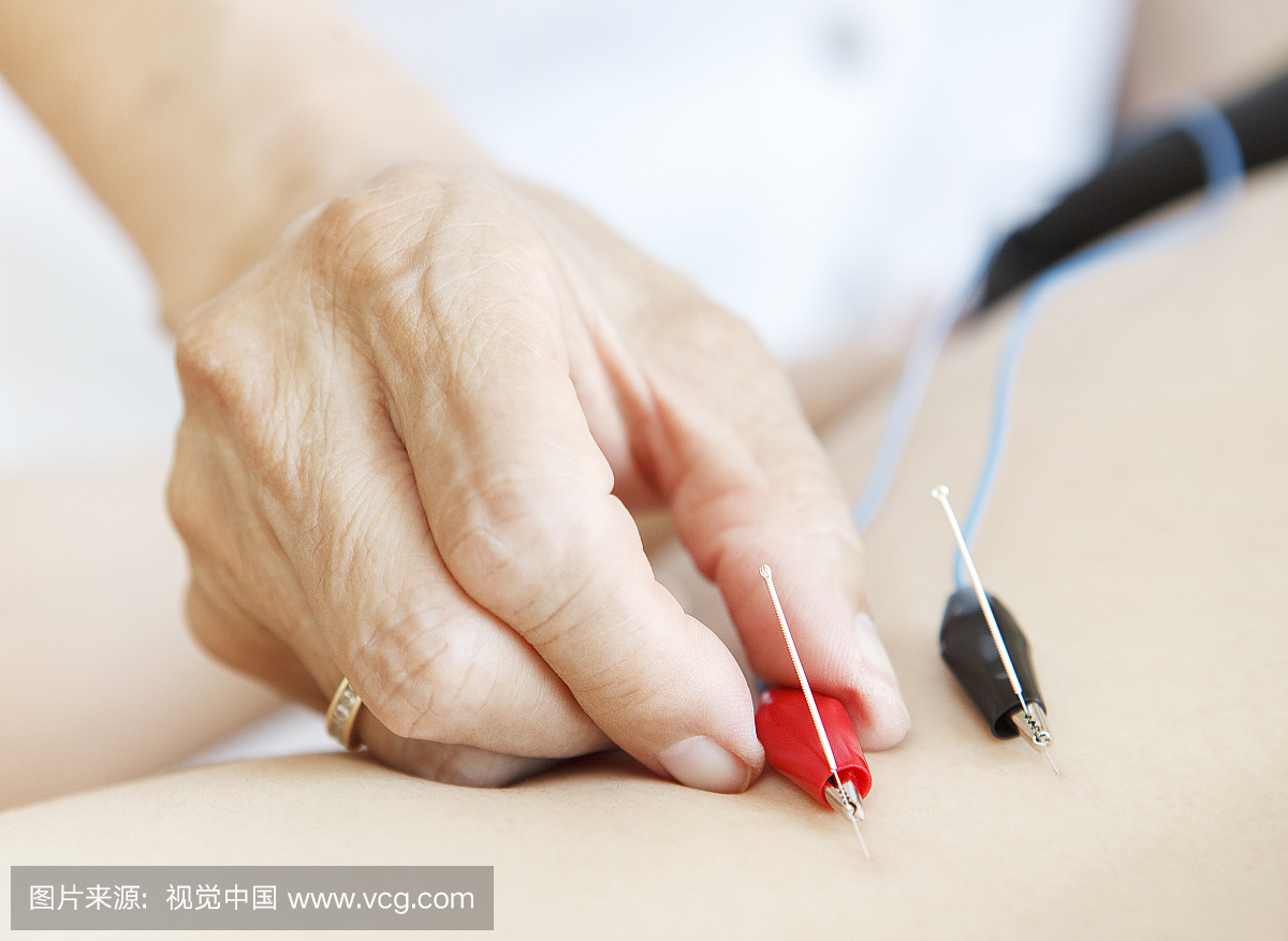 女人用电针做针灸