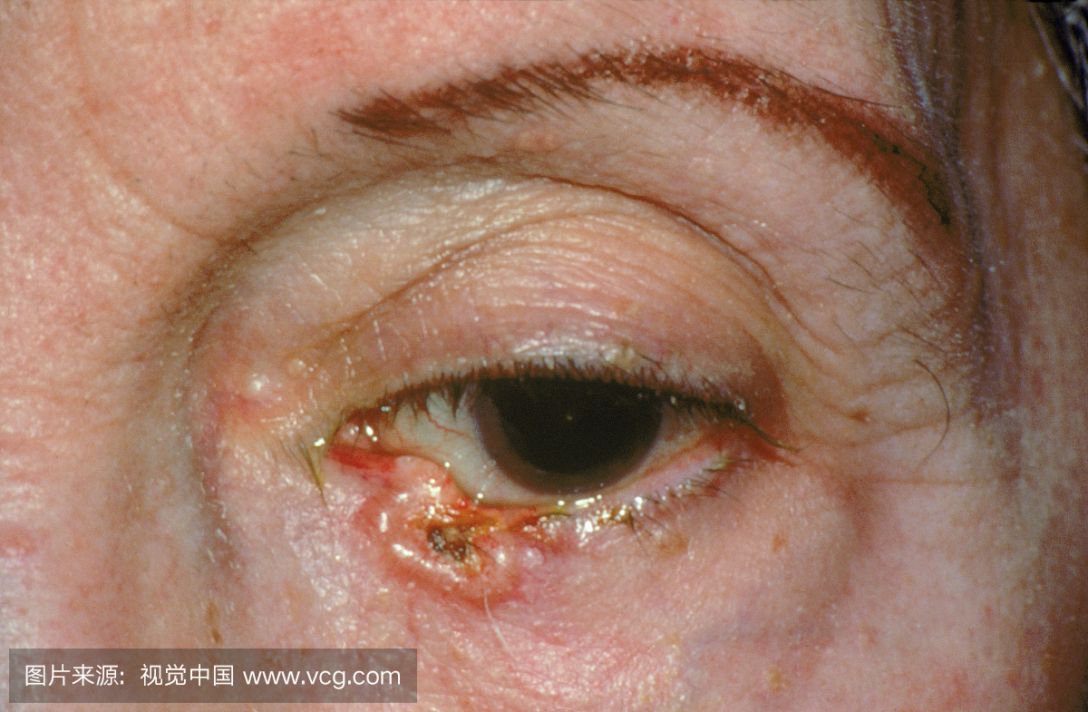 眼底基底细胞癌。这是皮肤癌中最常见的皮肤癌