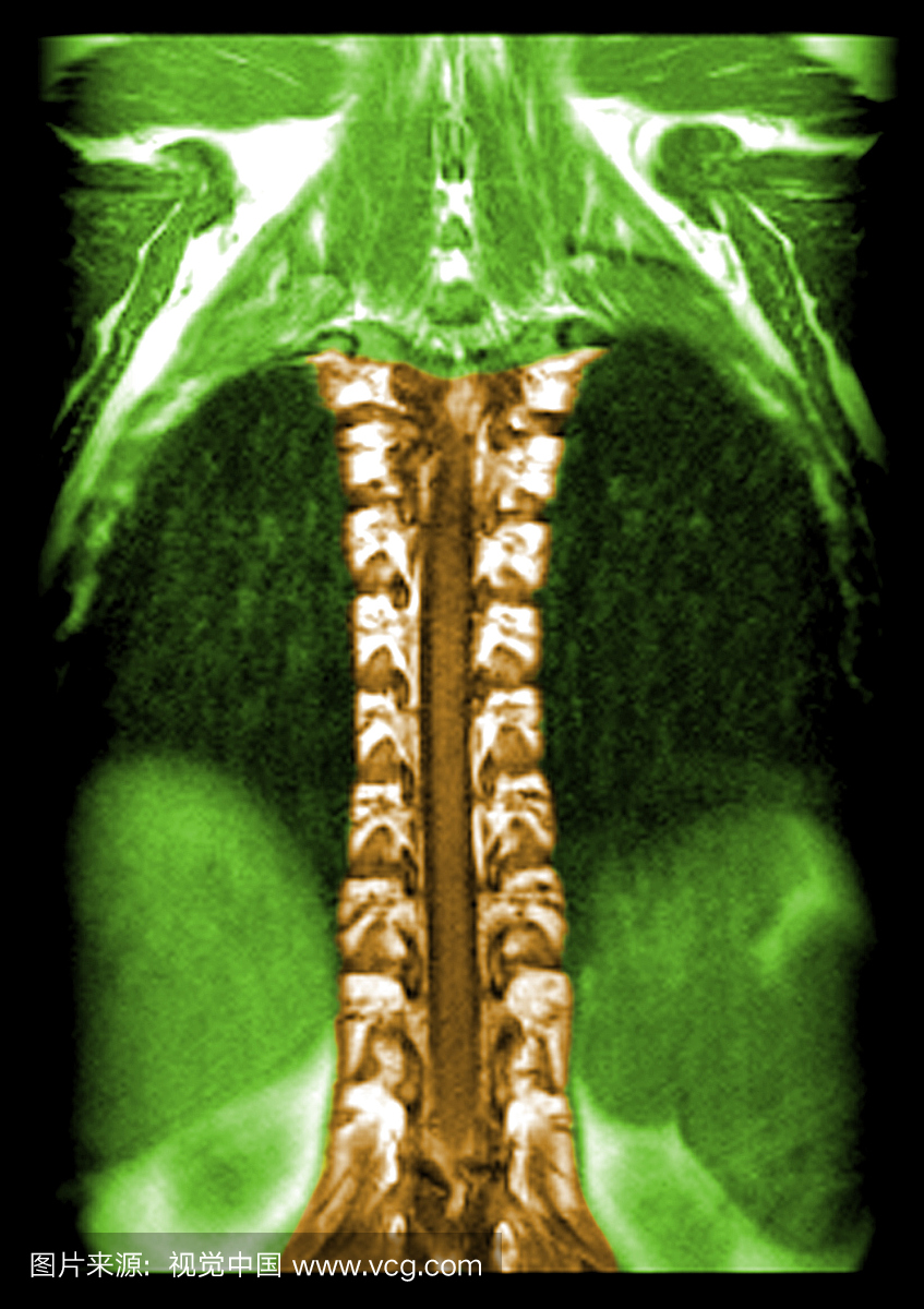 这种通过椎管平面的胸椎的冠状(正面)T1加权M