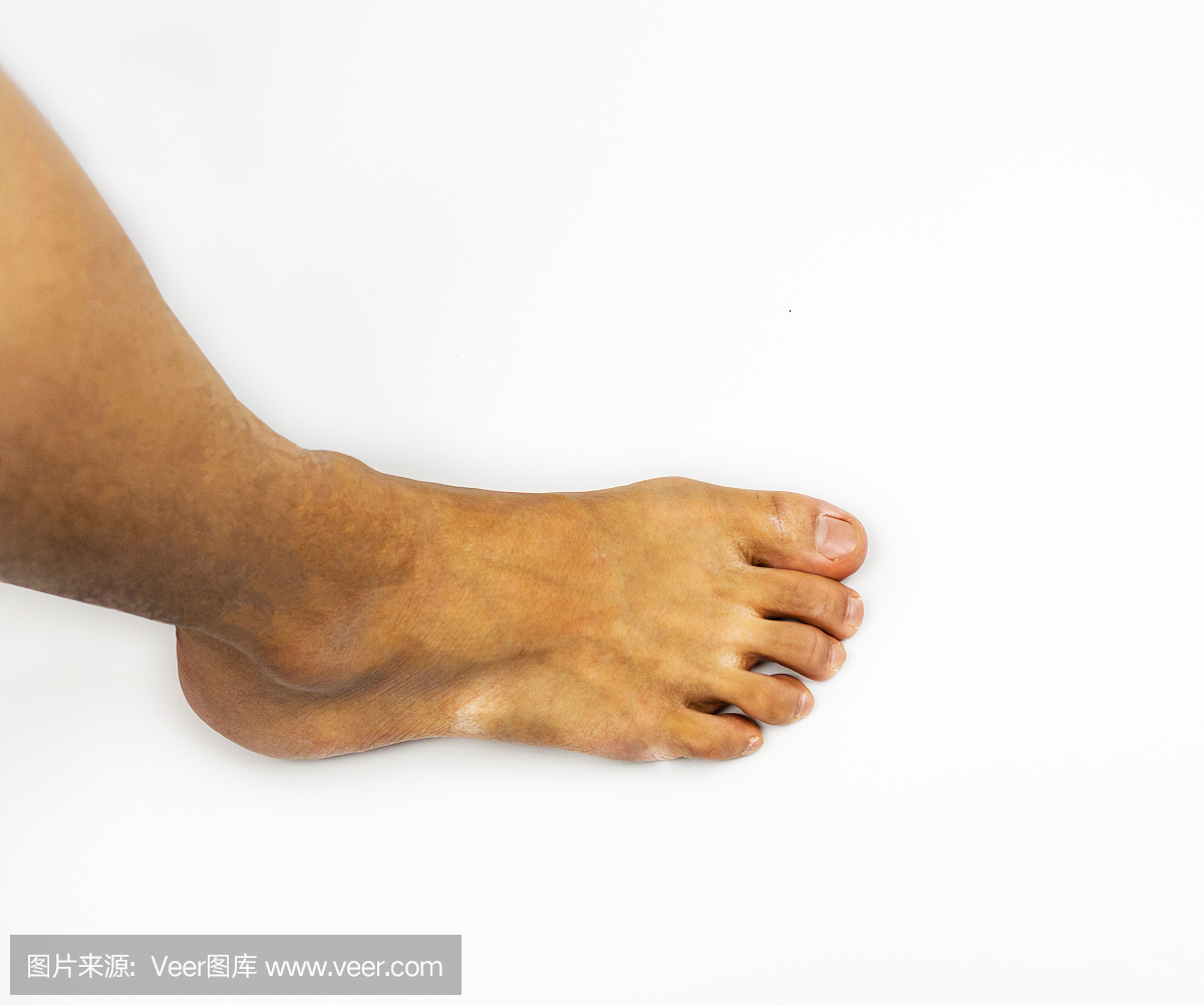 运动员的脚或脚癣,侧脚和腿在白色背景上