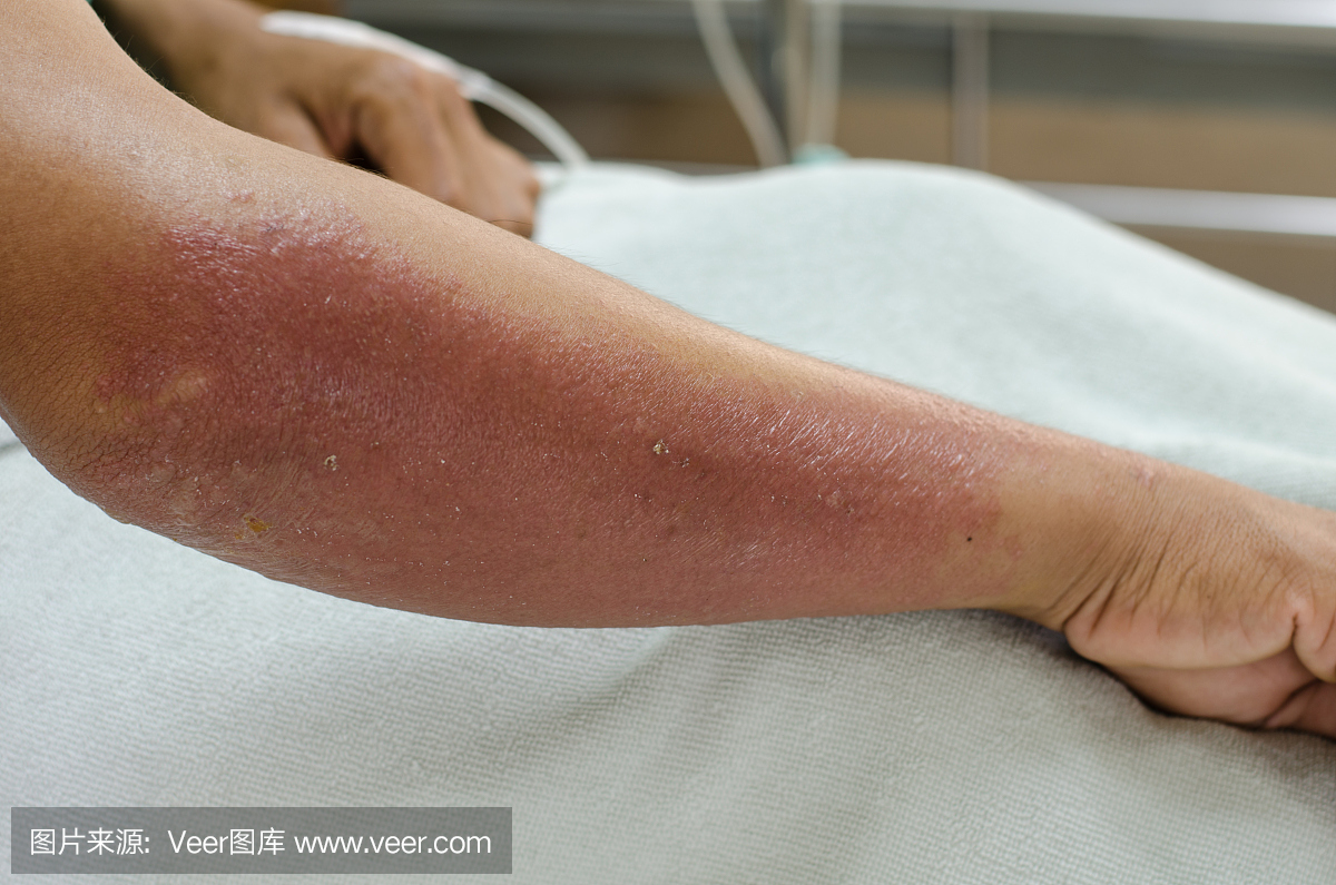 患者对除草剂过敏的手臂