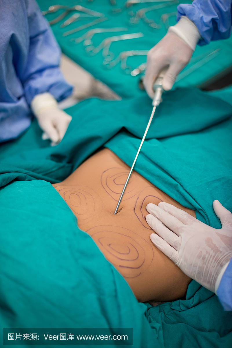 整形外科医生,整容医师,抽脂术,抽脂