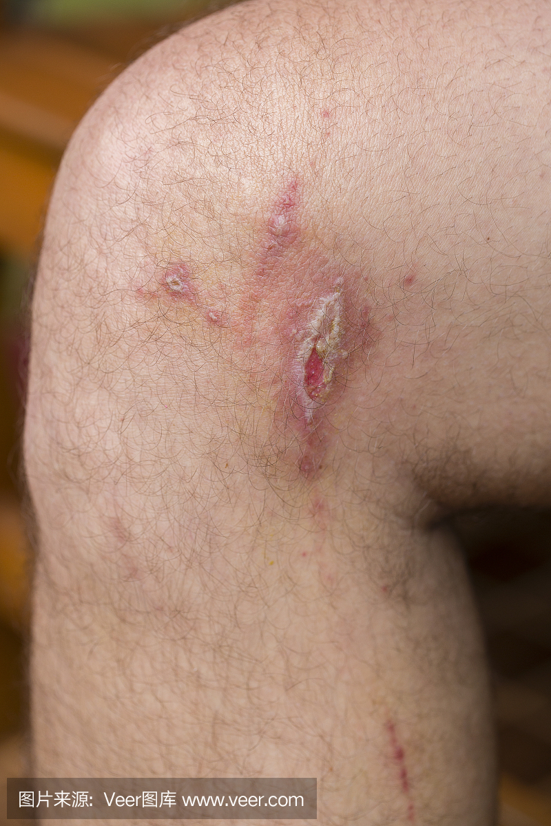 男人腿部刺激性接触性皮炎,关闭。