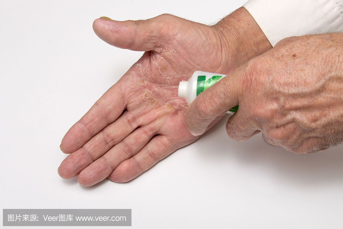 湿疹在手上。药膏在老人的手上。将软膏和润肤