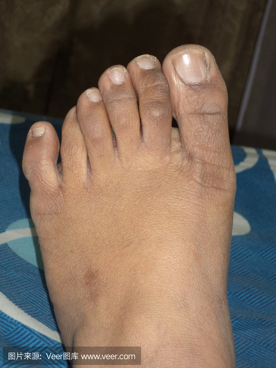 六只手指在左脚