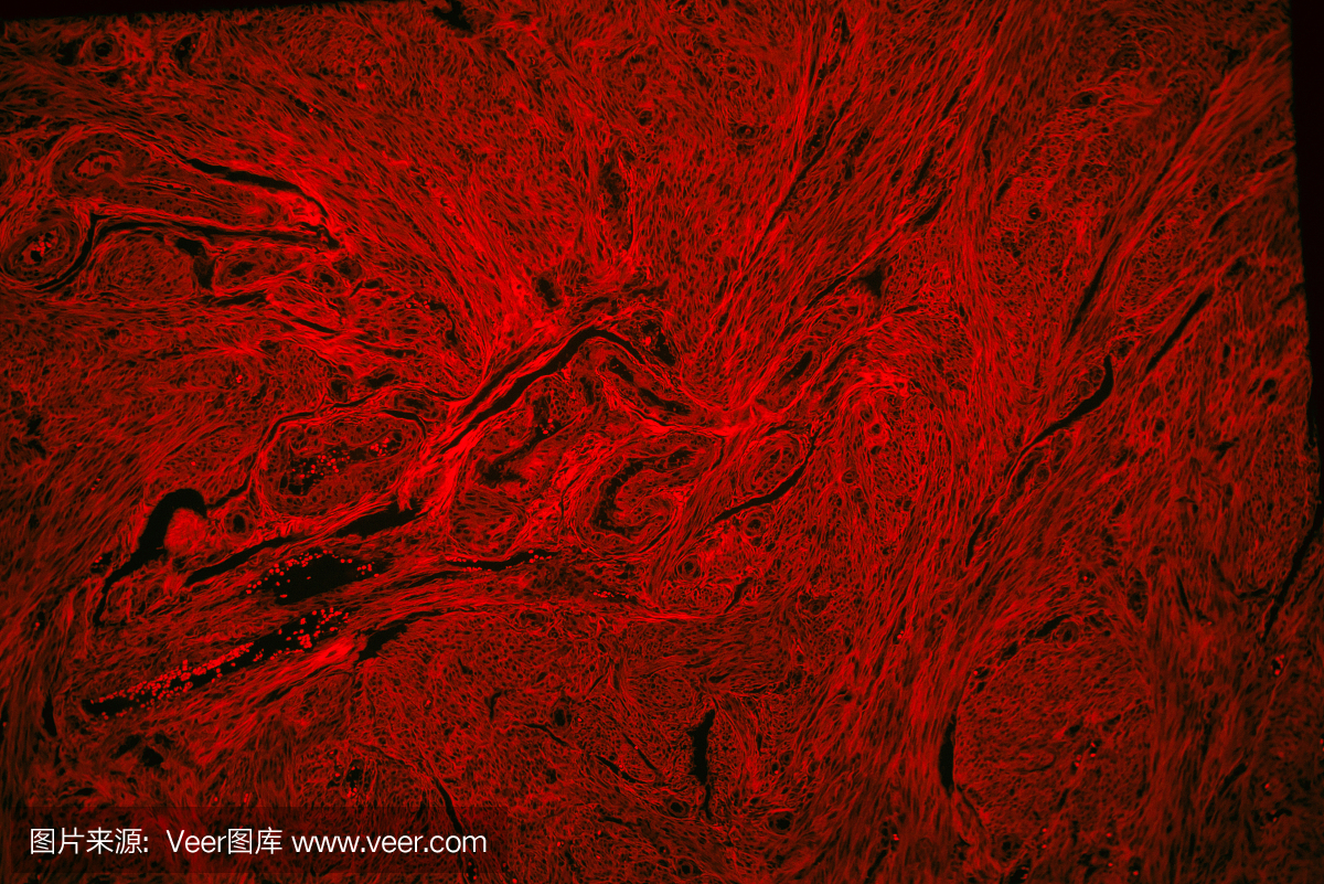人平滑肌瘤子宫肿瘤组织的红色荧光
