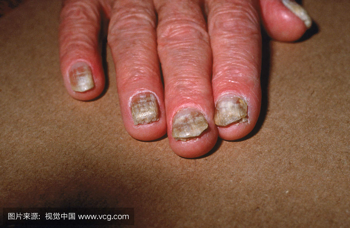 患者手指指甲上的真菌感染。治疗涉及将感染区