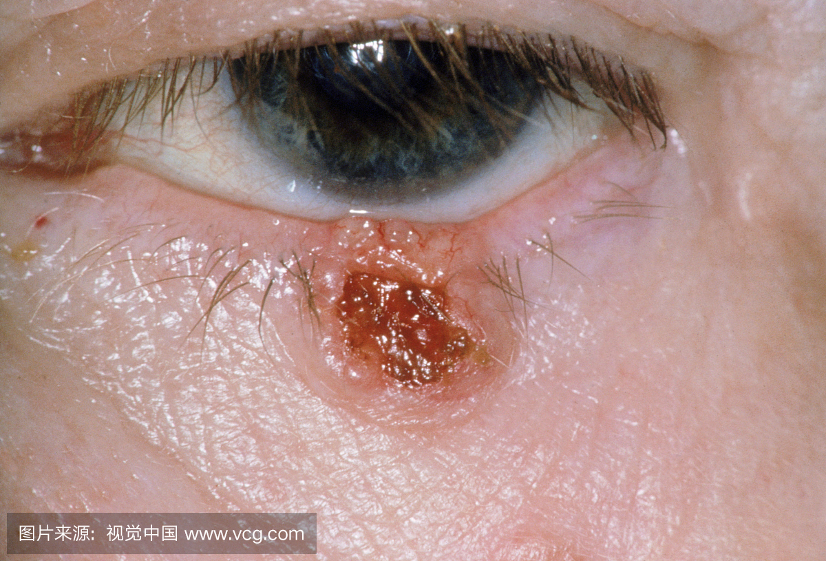 眼皮细胞基底细胞癌。这是皮肤癌中最常见的皮