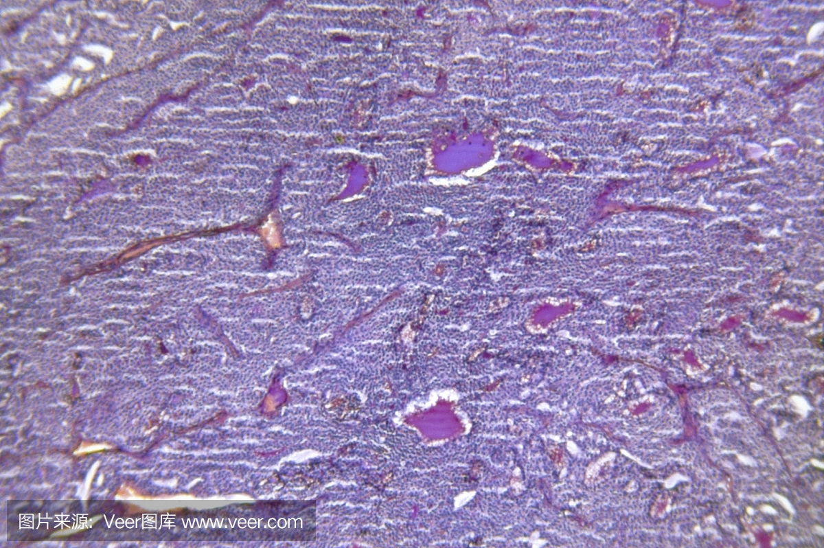 扩大甲状腺腺瘤性增生