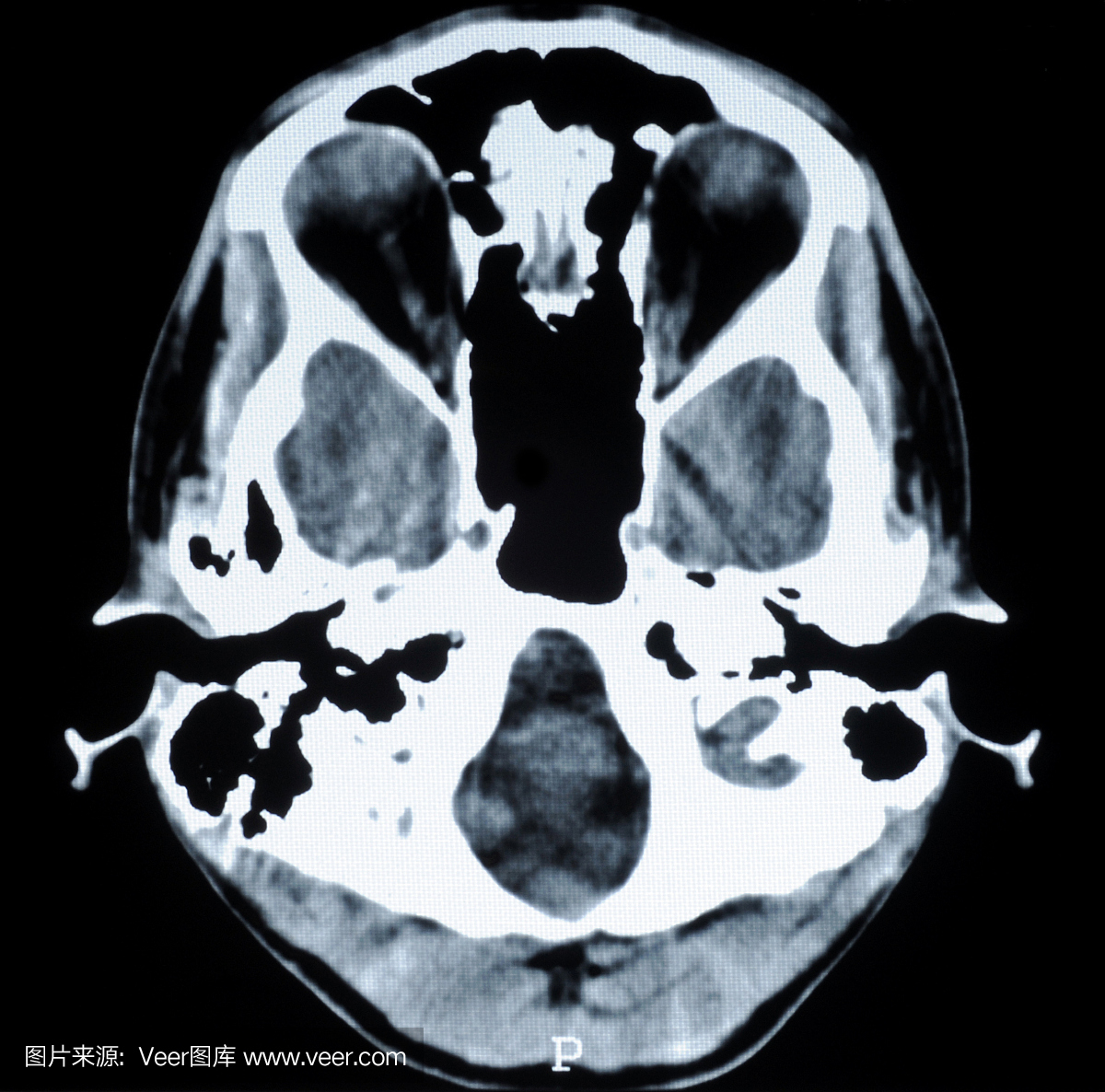 人脑CT照片