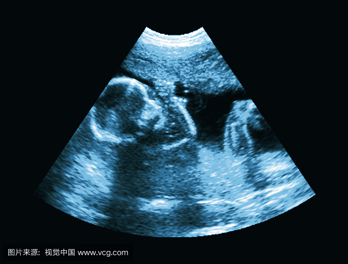 超声显示胎儿的侧视图。超声波是一种非侵入性