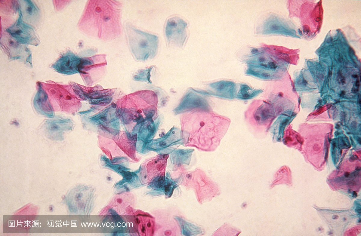 巴氏涂片显示正常的星状细胞和阴道细胞。