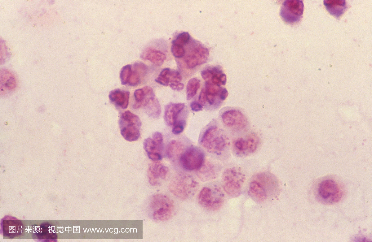 脓液的革兰氏染色显示淋病奈瑟氏球菌入侵白细