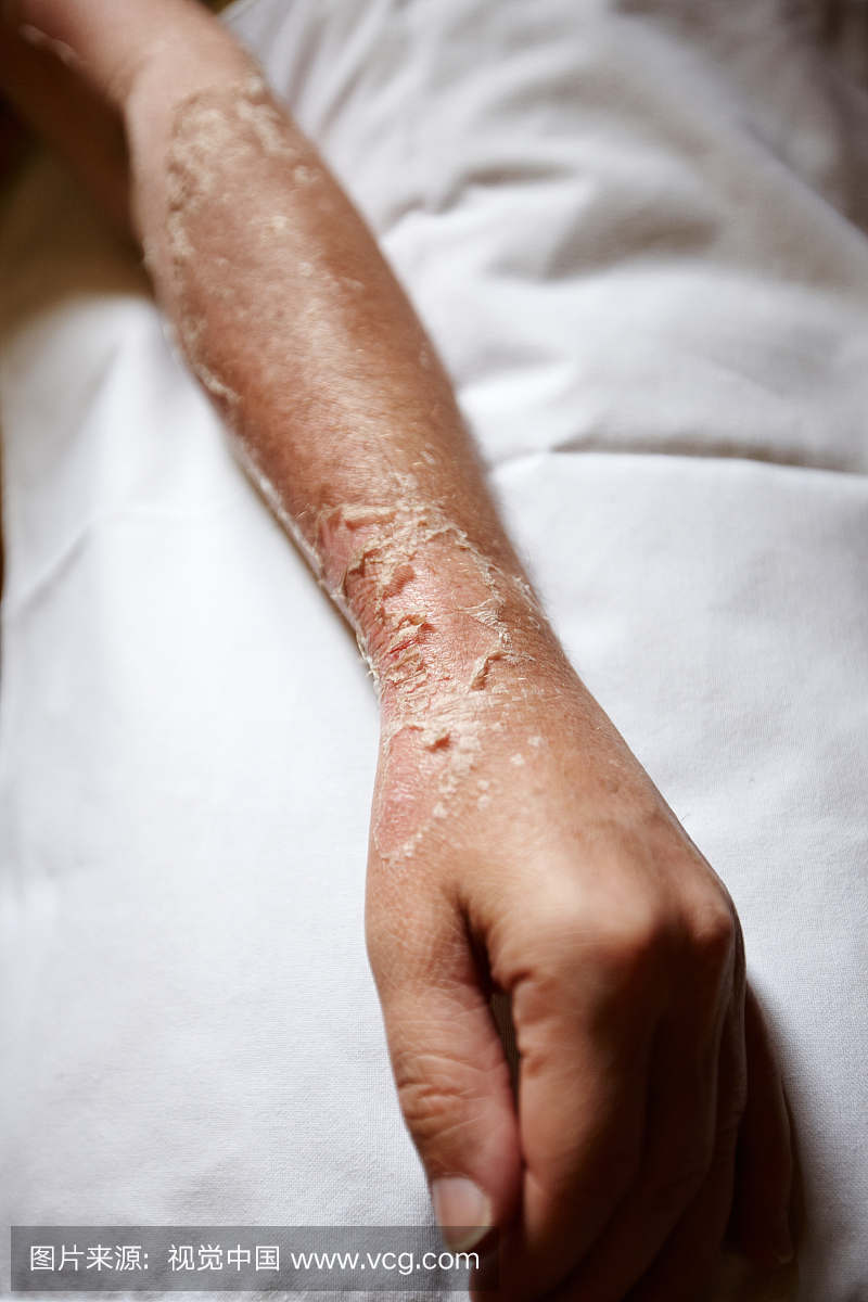 灼伤,晒伤,晒黑,晒伤的