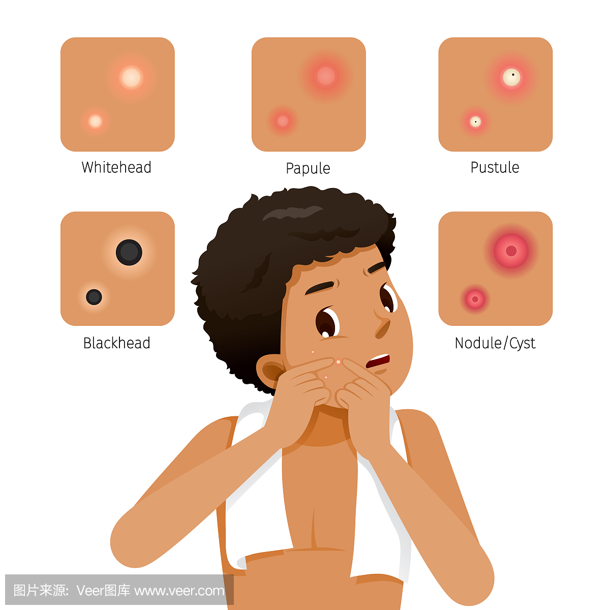 痤疮类型和晒黑的皮肤男人脸上的粉刺