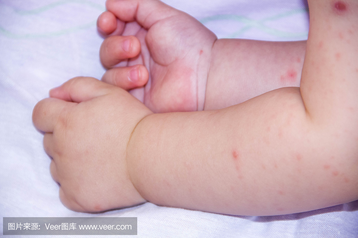 一小孩被湿疹覆盖。过敏宝宝皮肤皮炎食物。皮