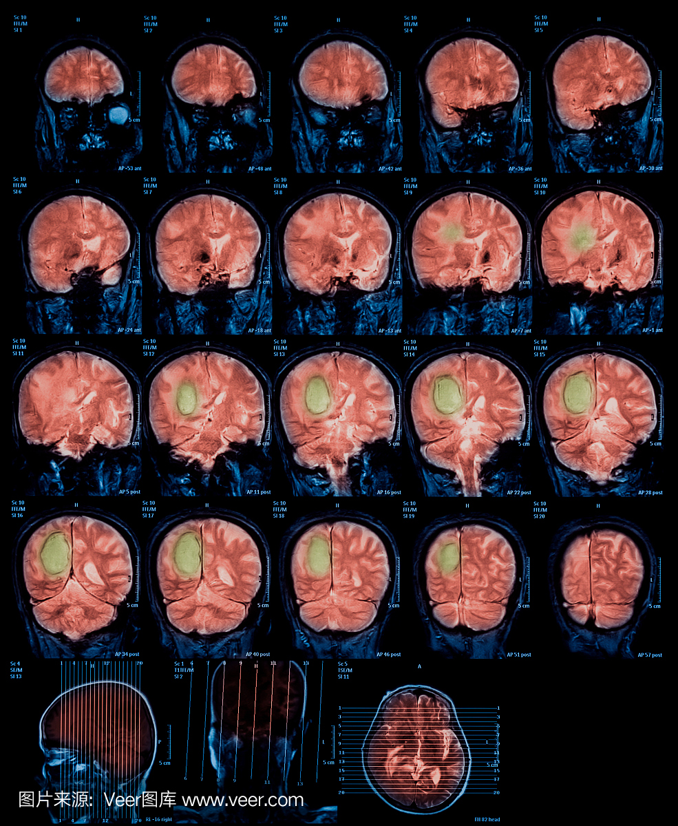 脑,脑肿瘤的磁共振成像(MRI)