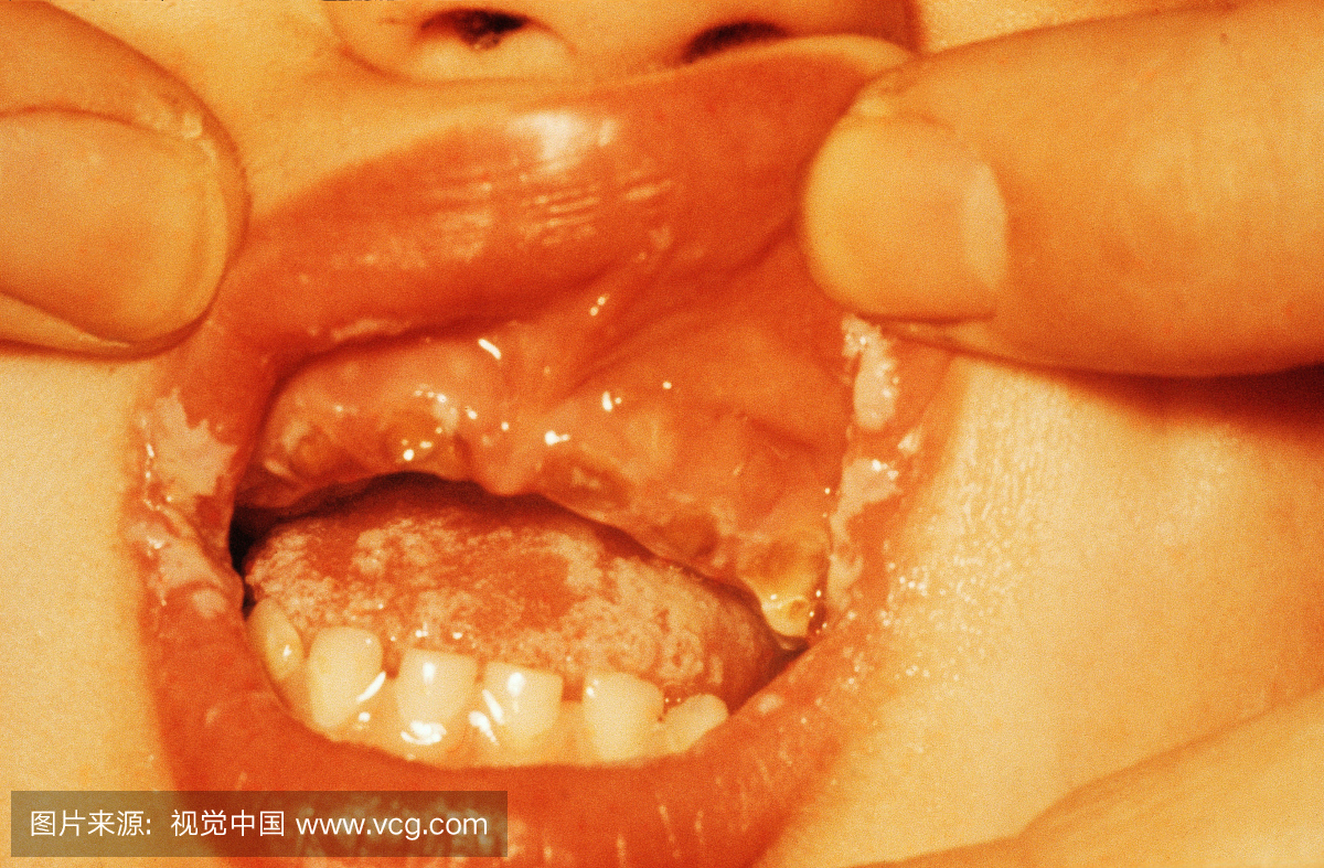 酵母感染(念珠菌病)的嘴唇和舌头。引起局部炎
