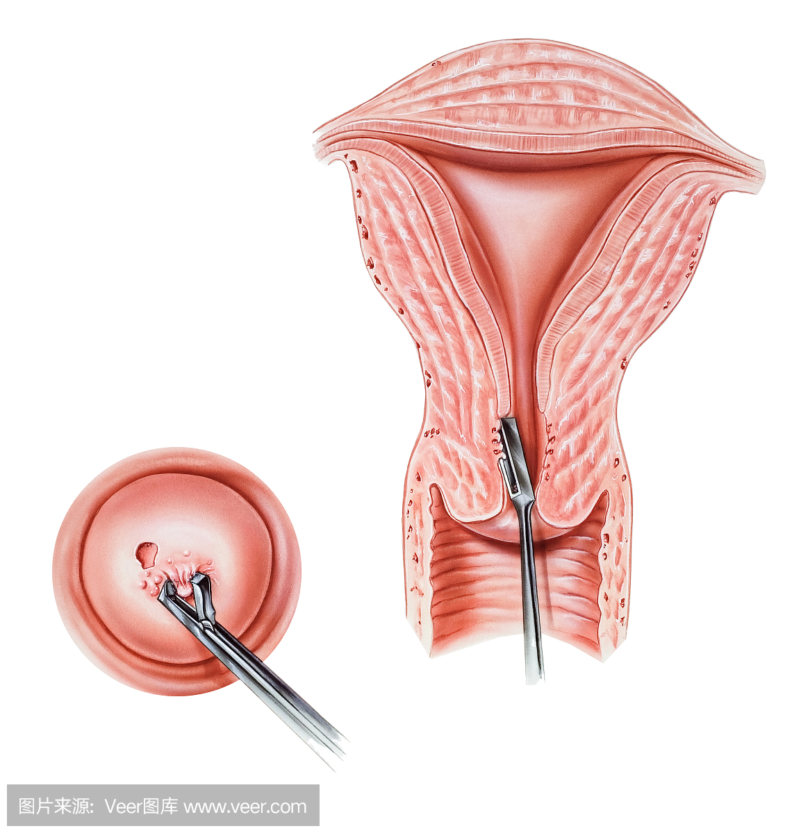 子宫颈内膜 - 活检