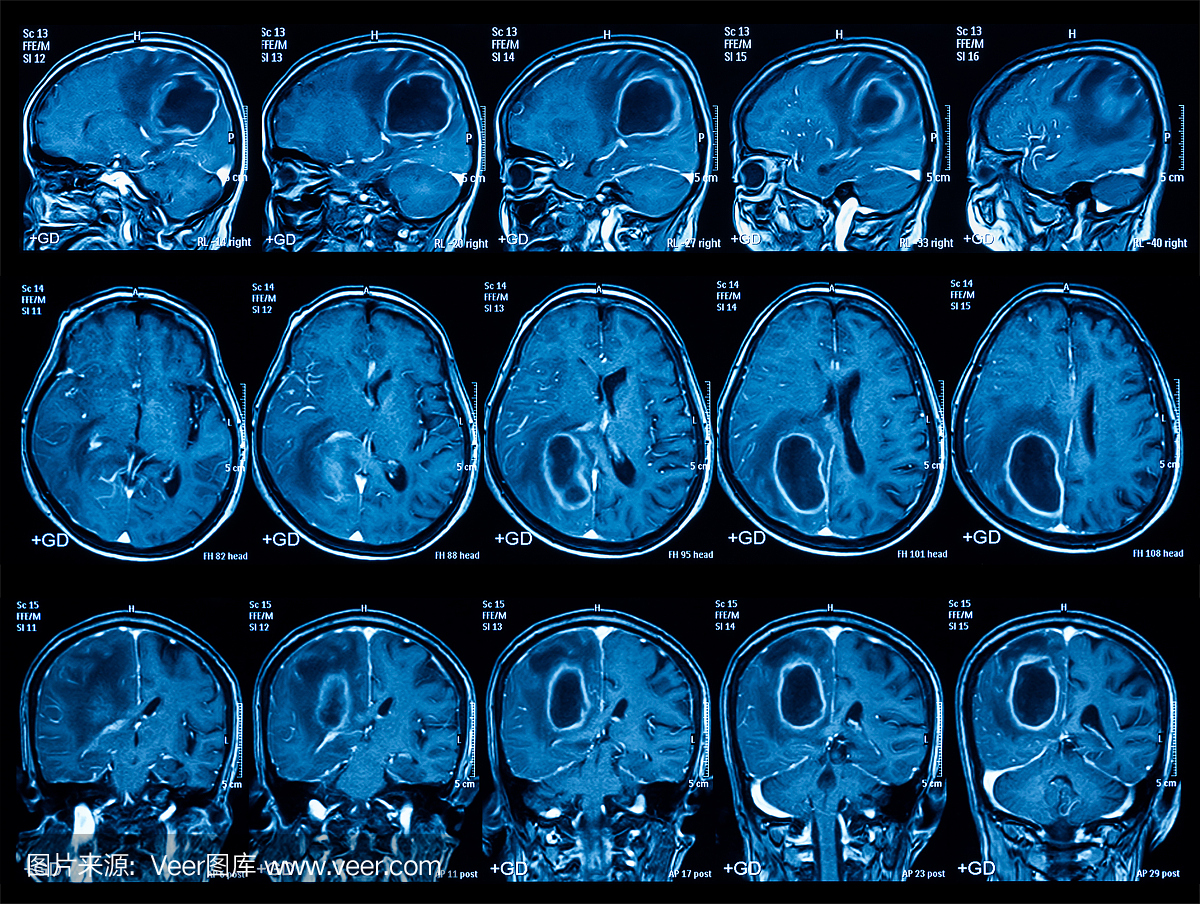 脑,脑肿瘤的磁共振成像(MRI)