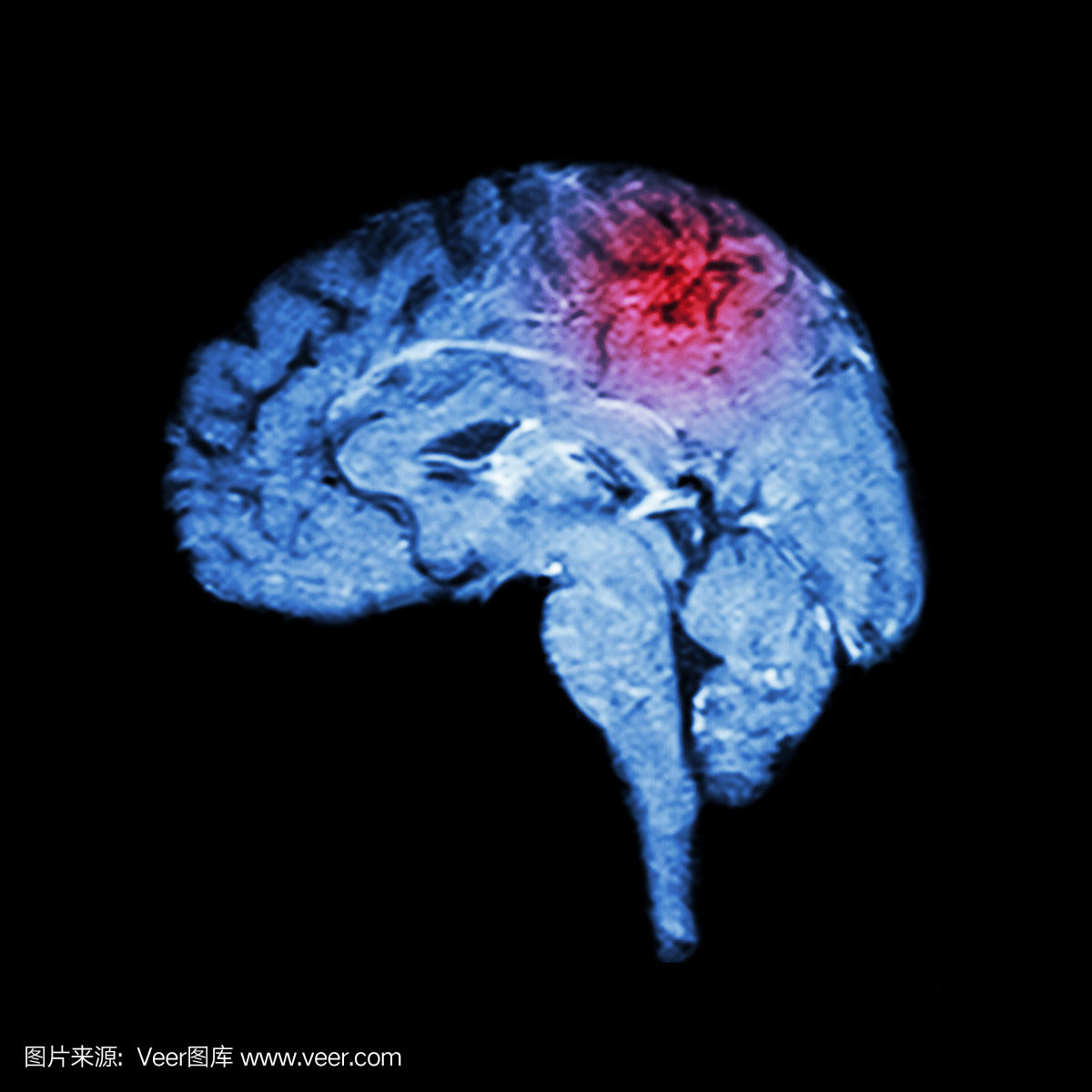 脑和脑卒中的磁共振成像(MRI)