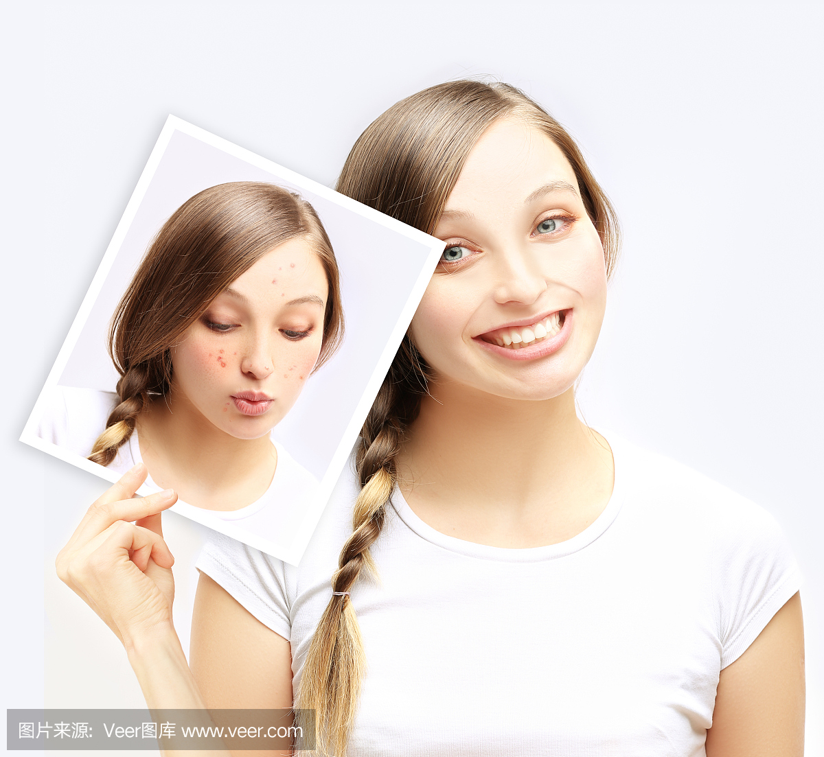 痤疮。快乐的十几岁的女孩显示自己与痤疮的照