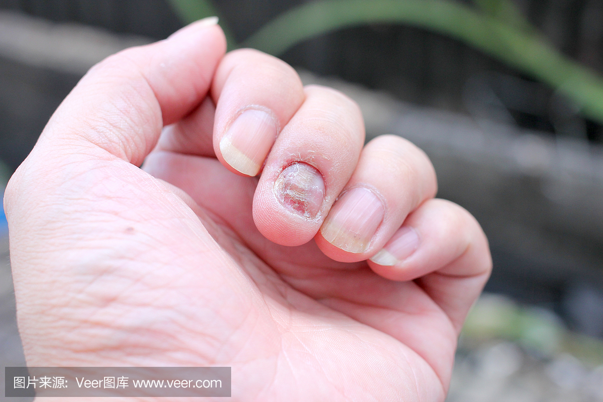 真菌感染指甲手,手指与甲真菌病。