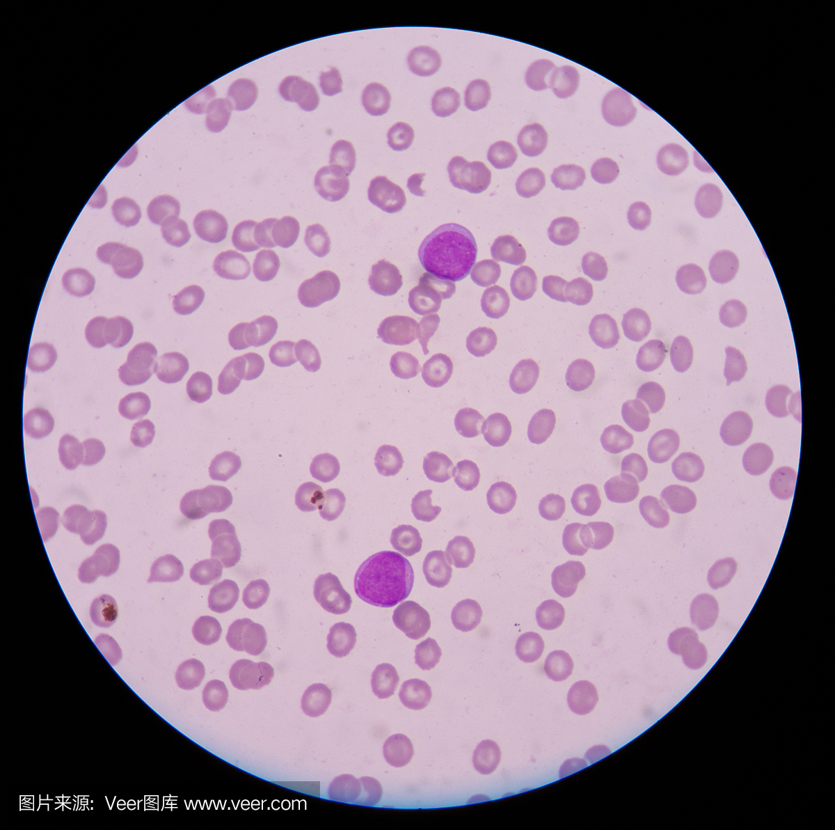 血液涂片显示急性成髓细胞白血病(AML)。