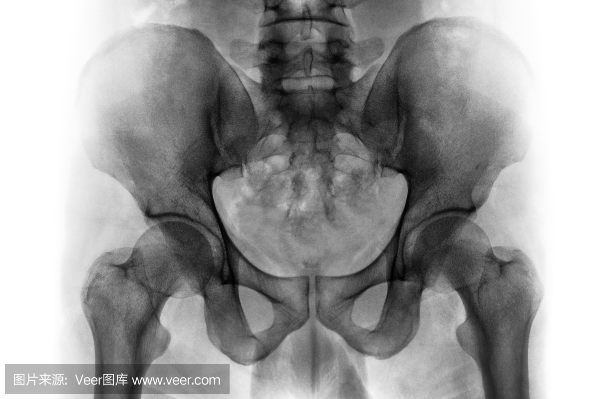 正常人骨盆和髋关节的X光片。