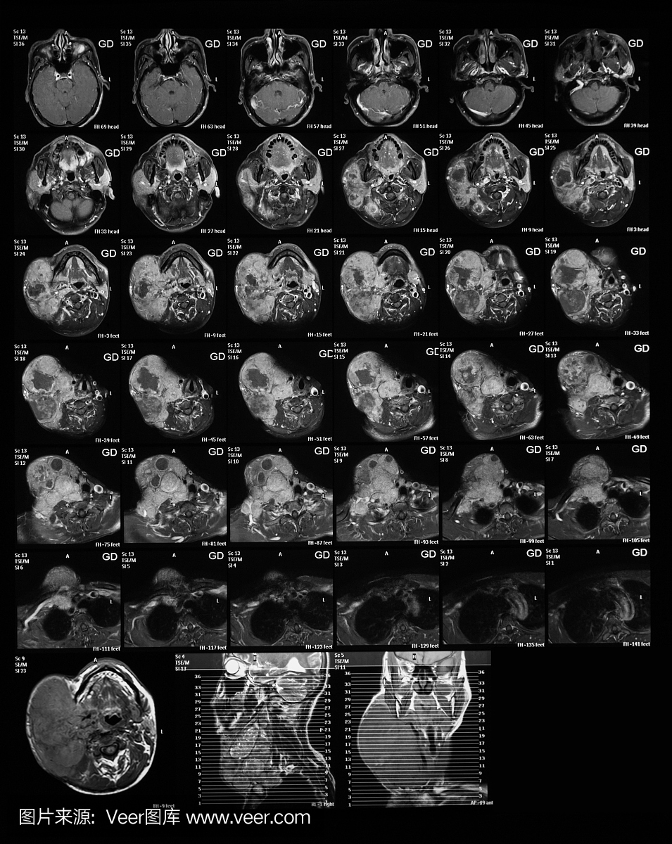 横向视图MRI(磁共振成像)的颈部