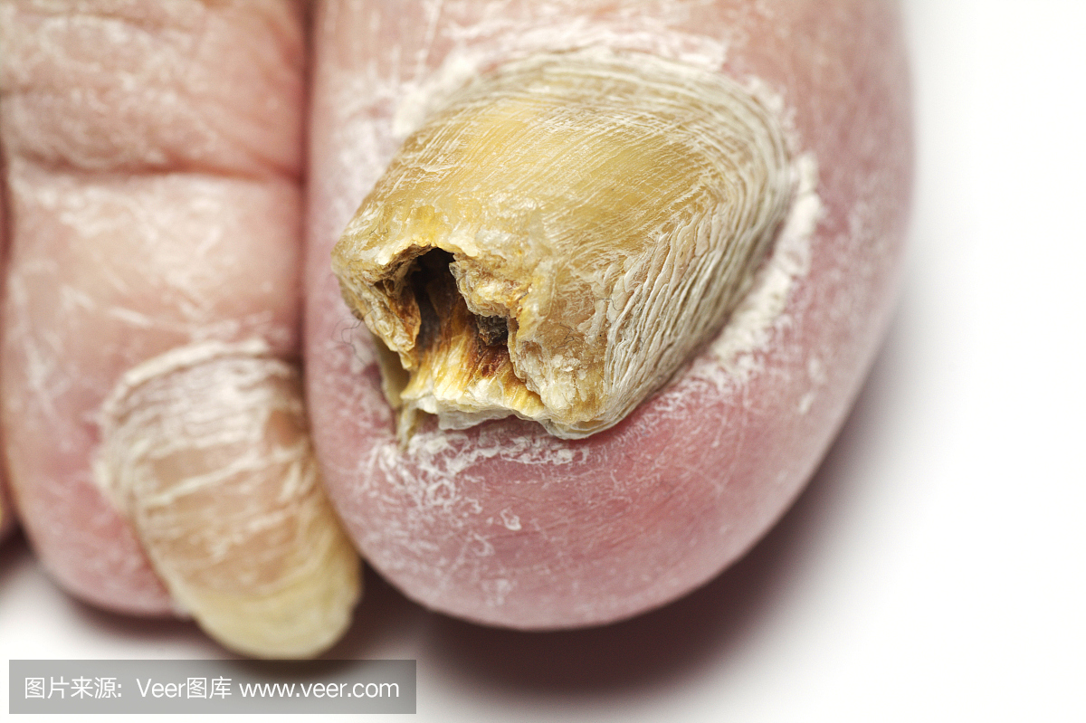 真菌性口炎,酵母感染,假丝酵母,念珠菌属