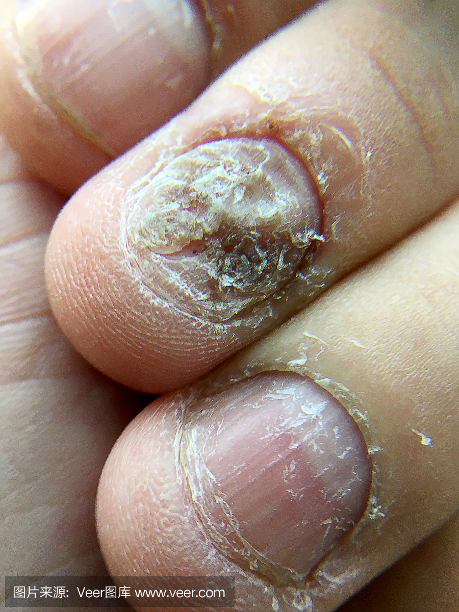 手指真菌感染图片_手指真菌感染的原因