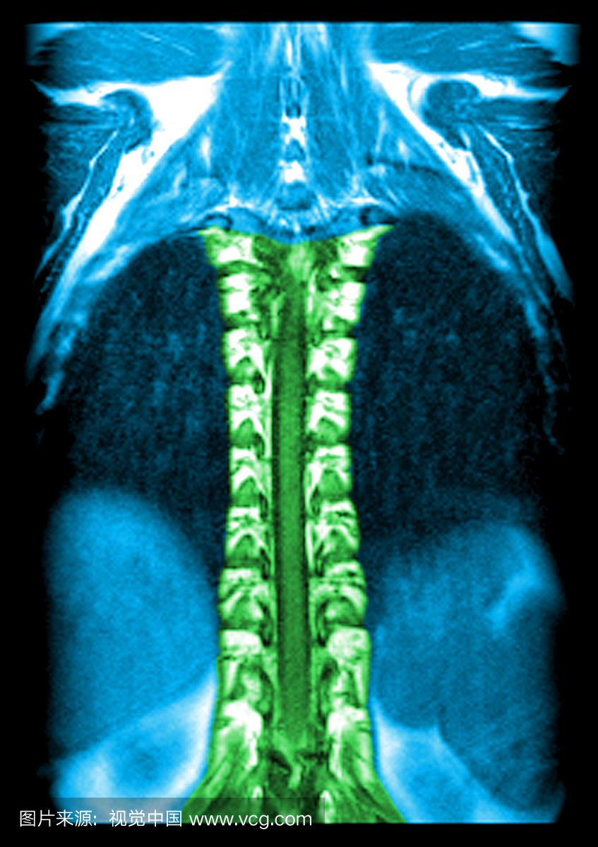 这种通过椎管平面的胸椎的冠状(正面)T1加权M