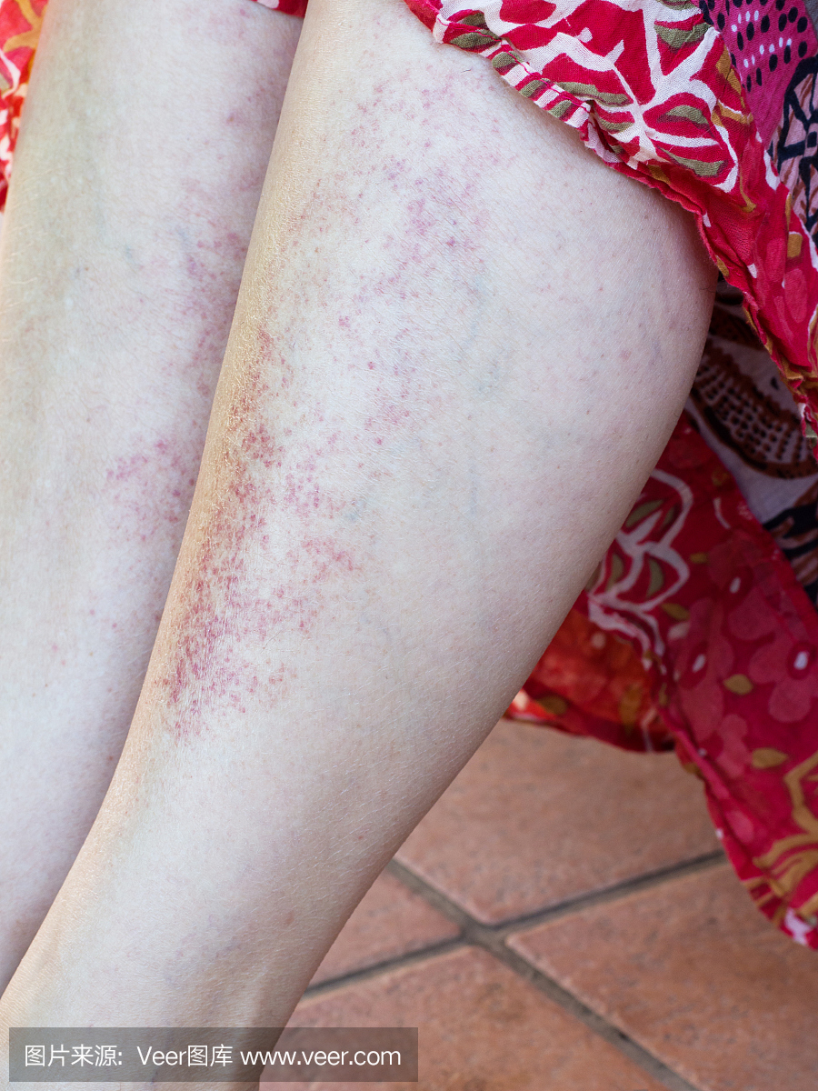 太阳不良反应,过敏,腿上红疹。