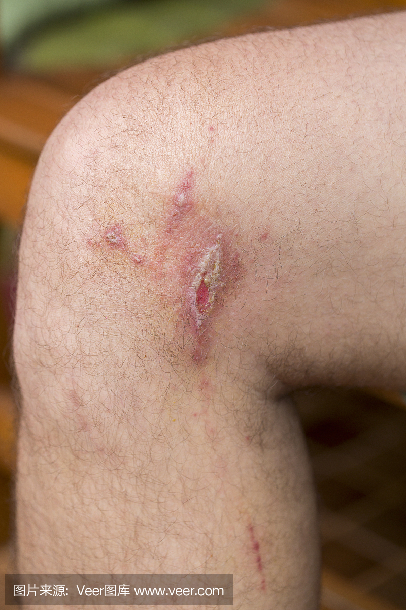 男人腿部刺激性接触性皮炎,关闭。
